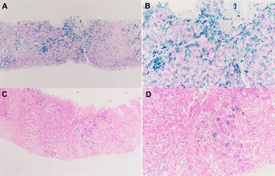 HFE-Related Hemochromatosis in a Chinese Patient: The First Reported Case